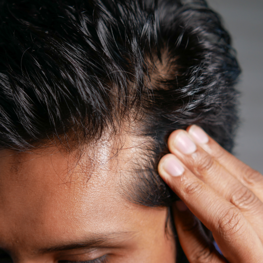 Chute de cheveux. Image illustrative