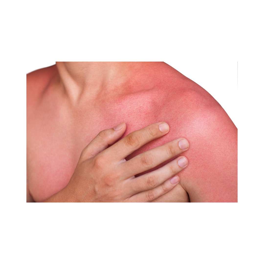 Brûlure peau. Image décorative